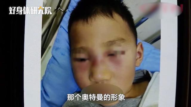 5岁男孩爱挖鼻孔，脸突然肿成“奥特曼”！医生紧急提醒