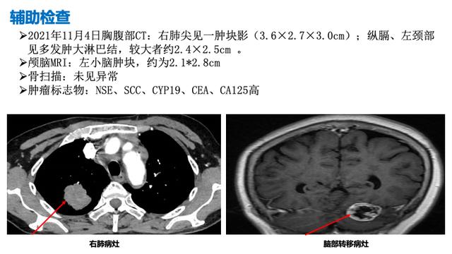 PPT檔案館｜一例國產三代TKI伏美替尼治療晚期肺腺癌的病例分享與思考