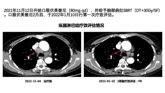 PPT檔案館｜一例國產三代TKI伏美替尼治療晚期肺腺癌的病例分享與思考