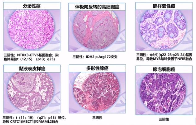 7大更新要點！專家解讀2022 CSCO乳腺癌指南病理診斷部分