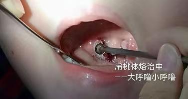 扁桃体角化物是什么