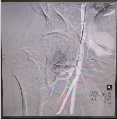 專科協作開新局 微創精準解頑疾 —— 市五院成功完成院內首例股骨頭缺血性壞死介入治療 - 
