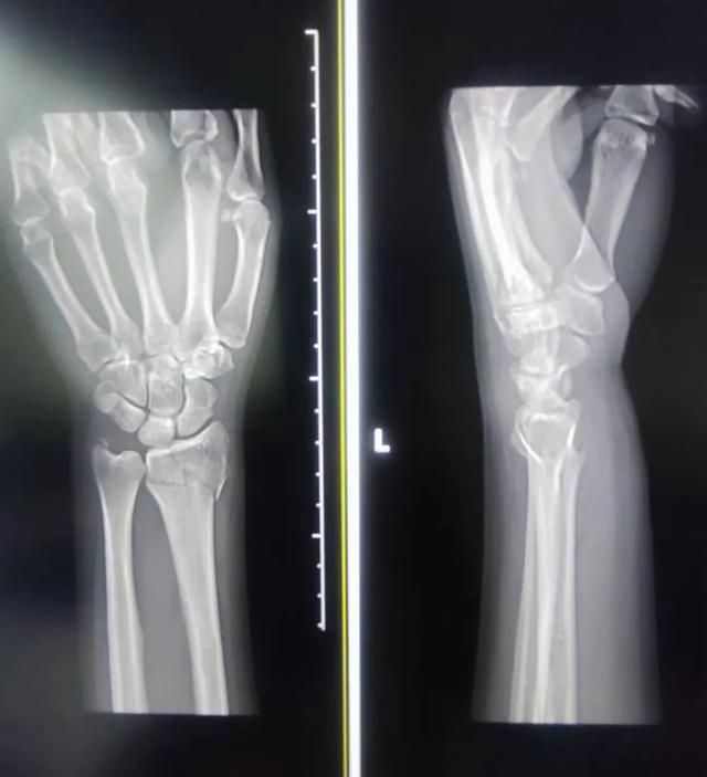 浙江初雪後，第一波骨折的人來急診“報到”了！醫生：今早接診多個，“骨折潮”來了