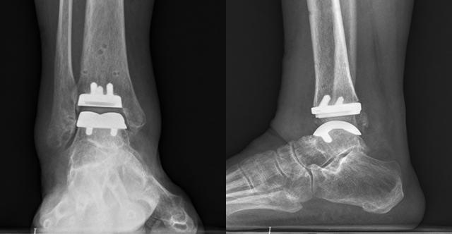 突破技術壁壘！連州人醫完成清遠首例人工全踝關節置換術 - 