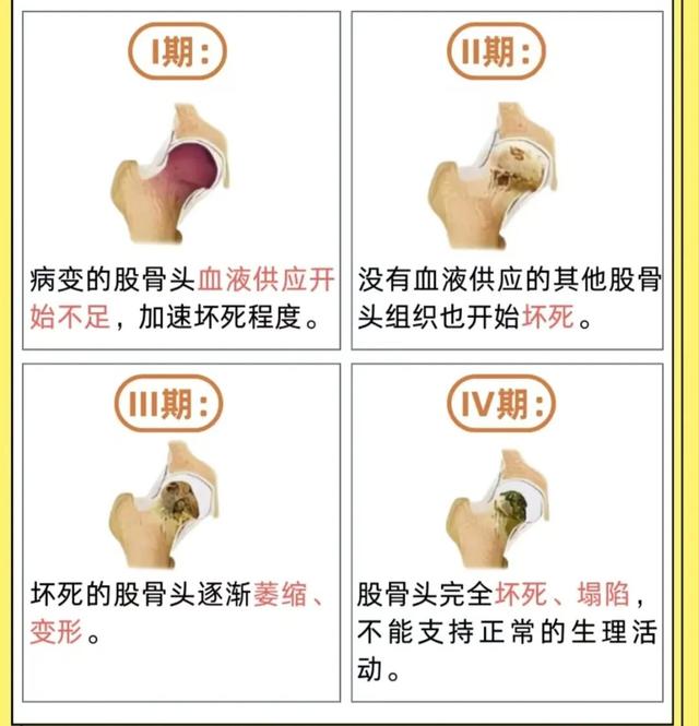 專科協作開新局 微創精準解頑疾 —— 市五院成功完成院內首例股骨頭缺血性壞死介入治療 - 