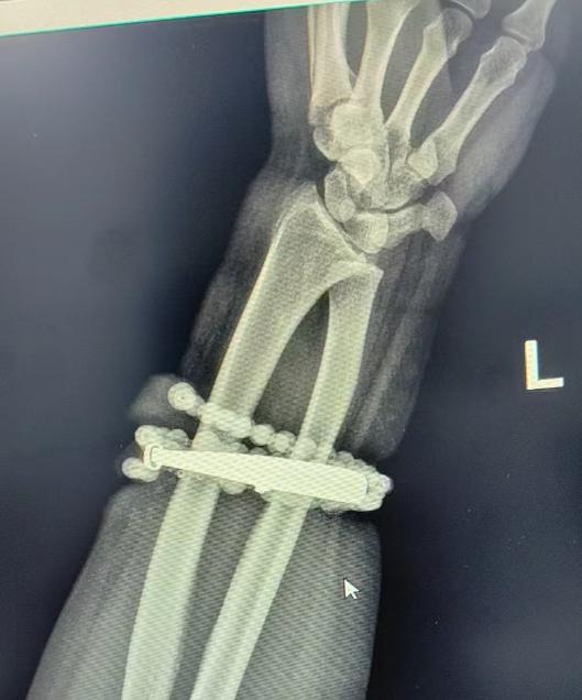 女子手鐲10年沒摘竟“長”進肉里！醫生：再晚點就保不住了 - 