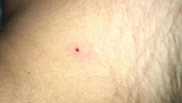 警惕！春日踏青需防範蜱蟲 - 