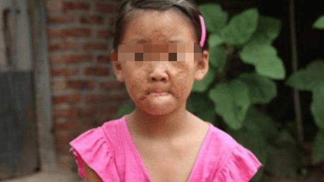 妈妈烧沸的一壶水，“夺走”了6岁女儿的脸