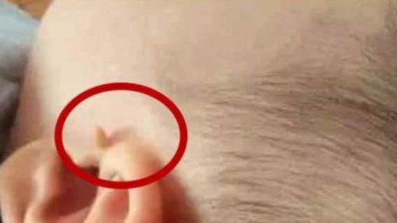 耳前的“拴马桩”您了解多少？