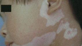 【孩子得了#白癜风# 之后情绪状态一直都不太好，怎么办？】

01、家长多注