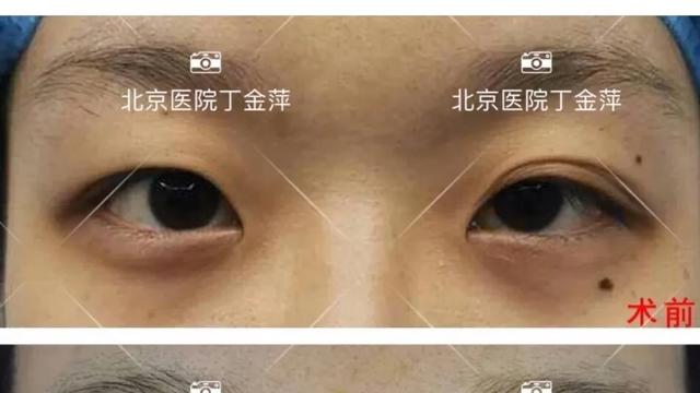 丁金萍美眼案例库
全切双眼皮案例分享
姑娘最大的问题是单侧（图右眼）提肌无力