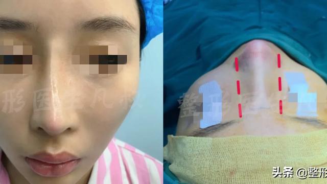 昨天有个姑娘私信问，在当地医院做了隆鼻手术，术前鼻子是歪的，面诊时医生也说了