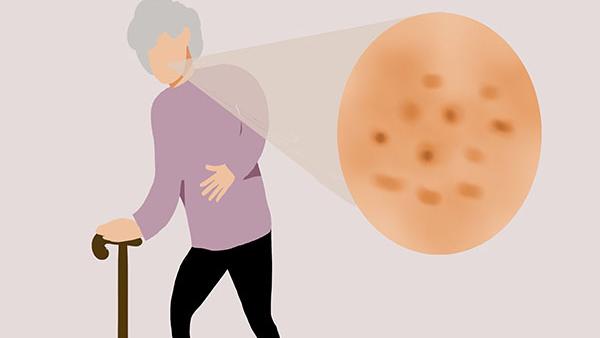 为什么有的人满脸老年斑，有的却干干净净？长老年斑，说明什么？