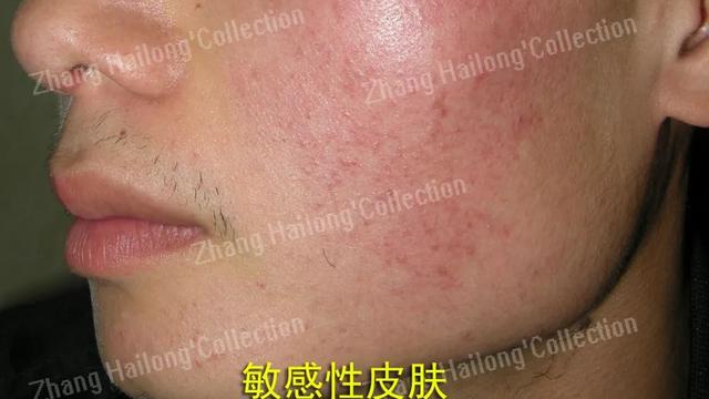 敏感肌自救指南来啦！你的皮肤为什么总“玻璃心”？