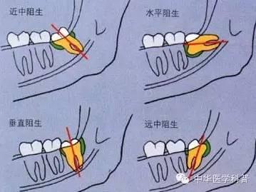 智齿是什么，智齿是什么年龄段长的（说说智齿的那些事儿）