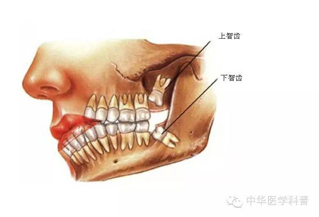 智齿是什么，智齿是什么年龄段长的（说说智齿的那些事儿）