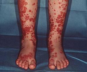 过敏性紫癜怎么治，过敏性紫癜怎么治疗能去根（过敏性紫癜的发病机理及理想的治疗方案）