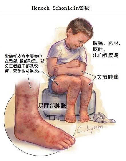 过敏性紫癜怎么治，过敏性紫癜怎么治疗能去根（过敏性紫癜的发病机理及理想的治疗方案）