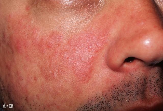 周海媚红斑狼疮,周海媚得了红斑狼疮(这些症状或是红斑狼疮的前兆)