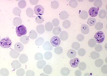 蜱虫病（蜱虫病毒），“蜱虫病”导致妇女死亡（什么叫蜱虫病）