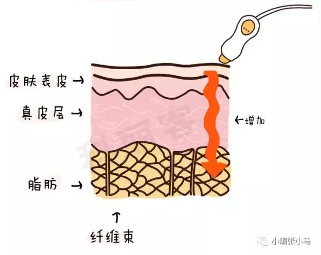 橘皮纹和肥胖纹的区别傻傻分不清,橘皮纹还是肥胖纹,要如何去除 橘皮纹和肥胖纹的区别傻傻分不清,橘皮纹还是肥胖纹,要如何去除