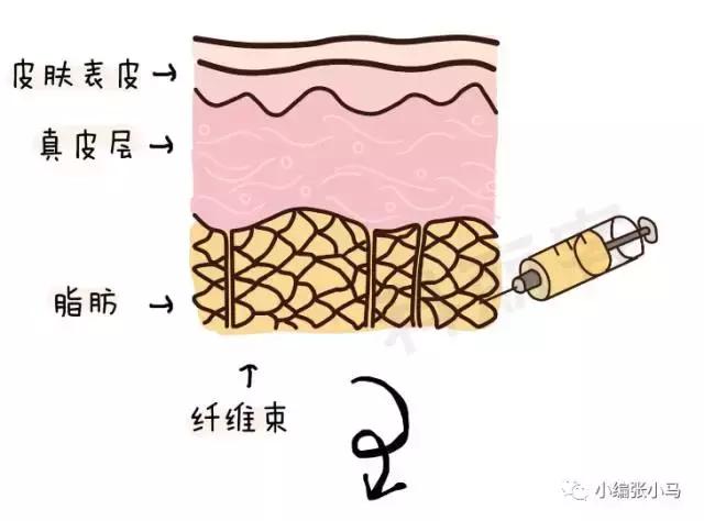 橘皮纹和肥胖纹的区别傻傻分不清,橘皮纹还是肥胖纹,要如何去除 橘皮纹和肥胖纹的区别傻傻分不清,橘皮纹还是肥胖纹,要如何去除