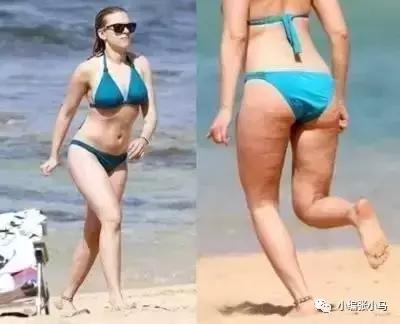 橘皮纹和肥胖纹的区别傻傻分不清,橘皮纹还是肥胖纹,要如何去除 橘皮纹和肥胖纹的区别傻傻分不清,橘皮纹还是肥胖纹,要如何去除