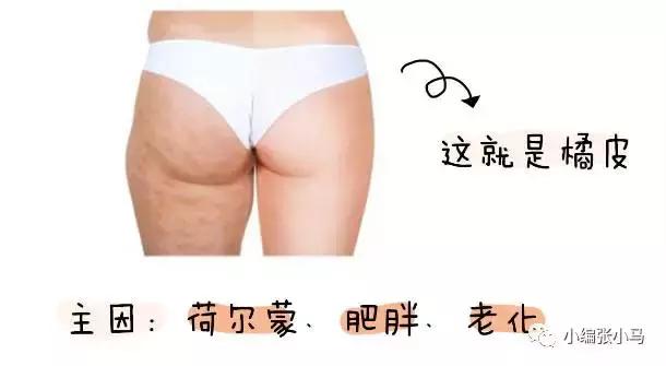 橘皮纹和肥胖纹的区别傻傻分不清,橘皮纹还是肥胖纹,要如何去除 橘皮纹和肥胖纹的区别傻傻分不清,橘皮纹还是肥胖纹,要如何去除