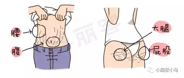 橘皮纹和肥胖纹的区别傻傻分不清,橘皮纹还是肥胖纹,要如何去除 橘皮纹和肥胖纹的区别傻傻分不清,橘皮纹还是肥胖纹,要如何去除