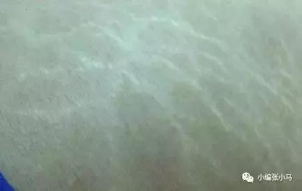 橘皮纹和肥胖纹的区别傻傻分不清,橘皮纹还是肥胖纹,要如何去除 橘皮纹和肥胖纹的区别傻傻分不清,橘皮纹还是肥胖纹,要如何去除