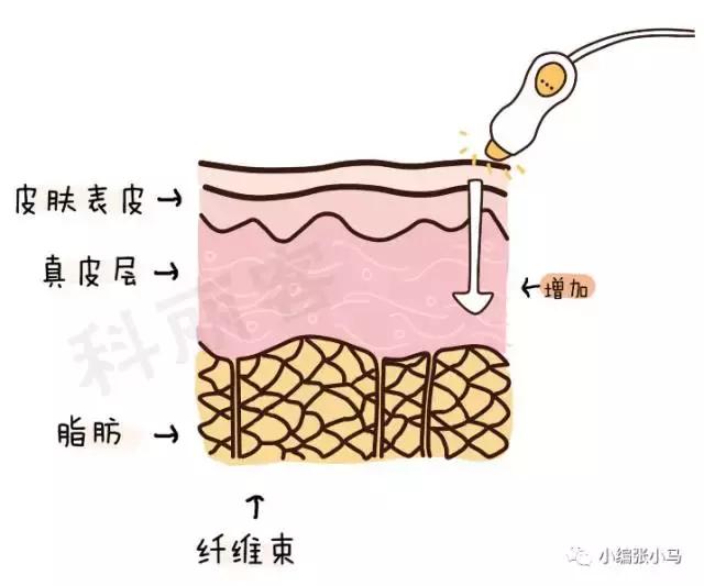 橘皮纹和肥胖纹的区别傻傻分不清,橘皮纹还是肥胖纹,要如何去除 橘皮纹和肥胖纹的区别傻傻分不清,橘皮纹还是肥胖纹,要如何去除