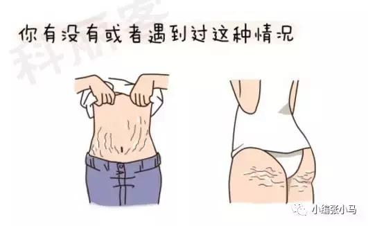 橘皮纹和肥胖纹的区别傻傻分不清,橘皮纹还是肥胖纹,要如何去除 橘皮纹和肥胖纹的区别傻傻分不清,橘皮纹还是肥胖纹,要如何去除