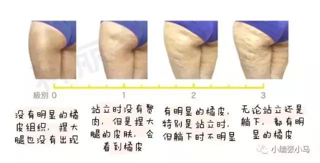 橘皮纹和肥胖纹的区别傻傻分不清,橘皮纹还是肥胖纹,要如何去除 橘皮纹和肥胖纹的区别傻傻分不清,橘皮纹还是肥胖纹,要如何去除