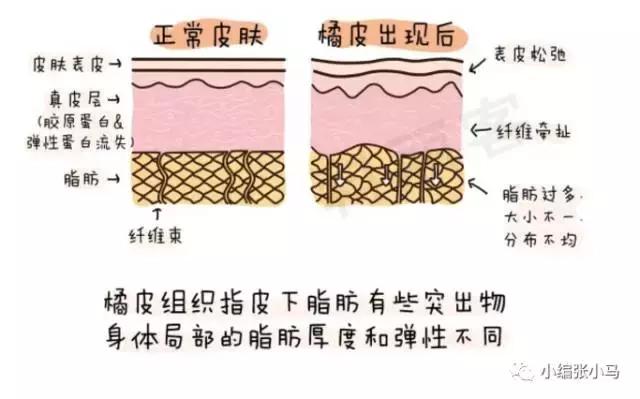 橘皮纹和肥胖纹的区别傻傻分不清,橘皮纹还是肥胖纹,要如何去除 橘皮纹和肥胖纹的区别傻傻分不清,橘皮纹还是肥胖纹,要如何去除