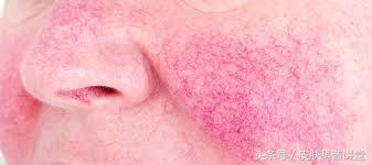 玫瑰痤疮是什么，什么是玫瑰痤疮（<玫瑰痤疮>的诊断及治疗专家共识）