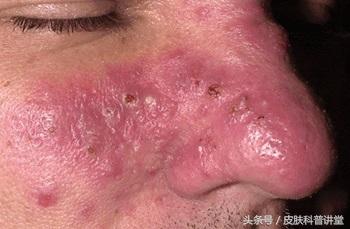 玫瑰痤疮是什么，什么是玫瑰痤疮（<玫瑰痤疮>的诊断及治疗专家共识）