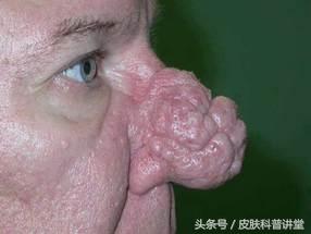 玫瑰痤疮是什么，什么是玫瑰痤疮（<玫瑰痤疮>的诊断及治疗专家共识）