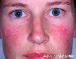 玫瑰痤疮是什么，什么是玫瑰痤疮（<玫瑰痤疮>的诊断及治疗专家共识）