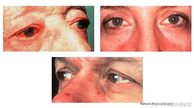 玫瑰痤疮是什么，什么是玫瑰痤疮（<玫瑰痤疮>的诊断及治疗专家共识）