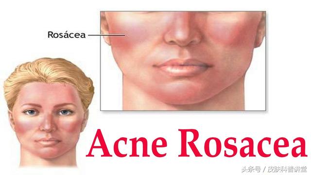 玫瑰痤疮是什么，什么是玫瑰痤疮（<玫瑰痤疮>的诊断及治疗专家共识）