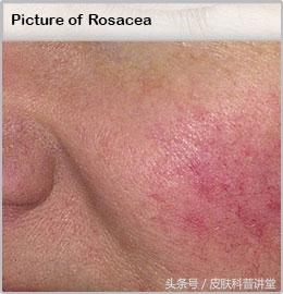 玫瑰痤疮是什么，什么是玫瑰痤疮（<玫瑰痤疮>的诊断及治疗专家共识）