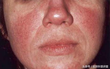 玫瑰痤疮是什么，什么是玫瑰痤疮（<玫瑰痤疮>的诊断及治疗专家共识）