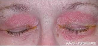 玫瑰痤疮是什么，什么是玫瑰痤疮（<玫瑰痤疮>的诊断及治疗专家共识）