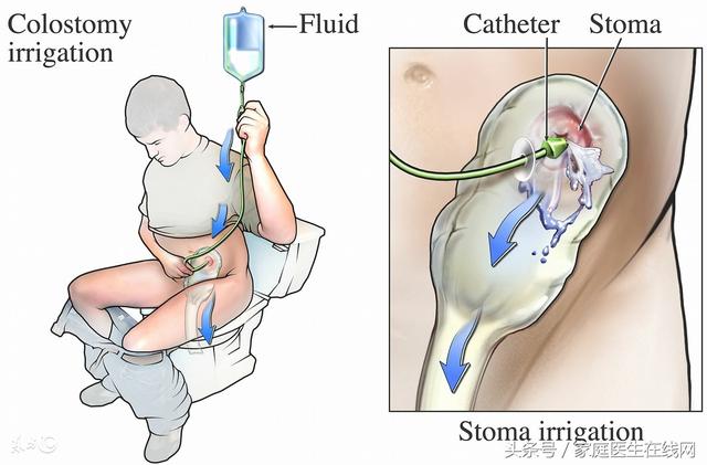 术后护理注意事项，腰椎手术术后护理注意事项（造口人术后还能跟正常人一样吗）