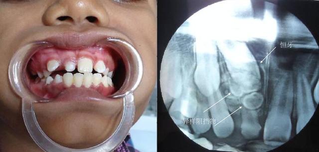 换门牙要多久时间才能长出来，儿童换牙期门牙掉了多长时间长出来（但孩子的新牙迟迟不来）