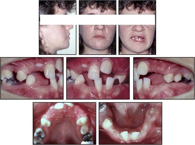 换门牙要多久时间才能长出来，儿童换牙期门牙掉了多长时间长出来（但孩子的新牙迟迟不来）