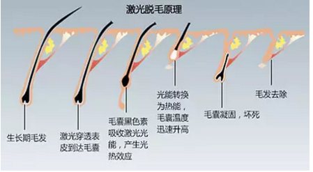 男士胡须永久脱毛大约多少钱，男士胡须彻底脱毛大约多少钱（是不是以后不会再长了）