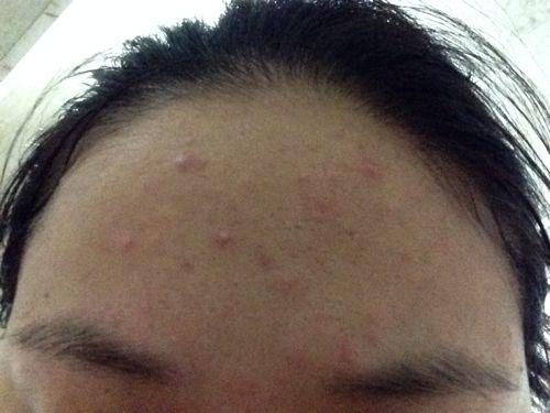 额头痤疮怎么办，额头上长痤疮怎么办（4个方法助你去除额头痘）