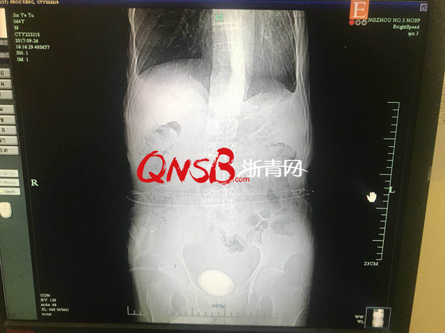 尿流率正常值是多少，尿流率正常值是多少女性（杭州一60岁大伯膀胱里长出一颗网球大的结石）