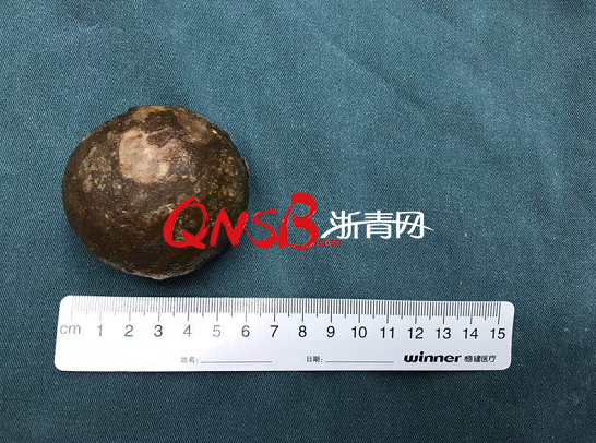 尿流率正常值是多少，尿流率正常值是多少女性（杭州一60岁大伯膀胱里长出一颗网球大的结石）